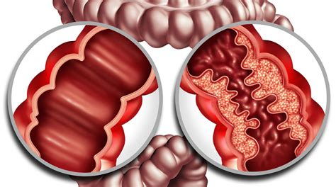 Crohns disease